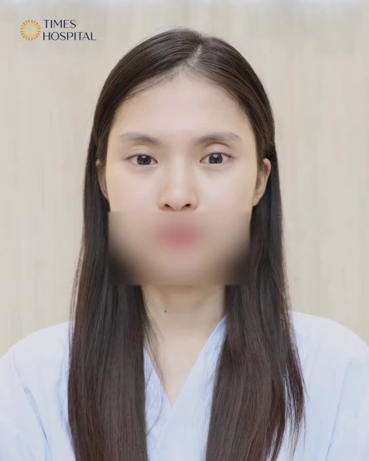 CẬP NHẬT KẾT QUẢ CA CẮT MÍ TRÊN CẤY MỠ HỐC MẮT!