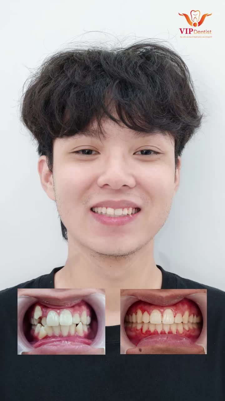 RĂNG KHẤP KHỂNH - KHÔNG CÓ CHỖ - KHÔNG NHỔ RĂNG SAO MÀ ĐỀU ĐƯỢC?