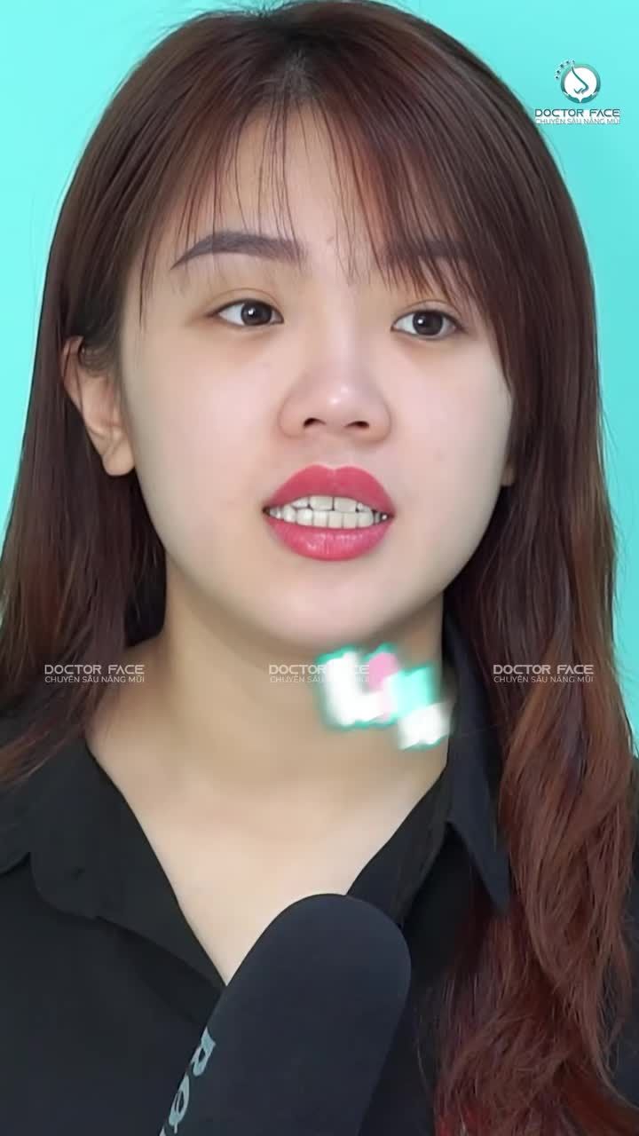 Từ Hà Nội vào Sài Gòn để nâng m.ũi, vì 3 người chị của bạn ấy đều đã làm mũi tại Dr Face.