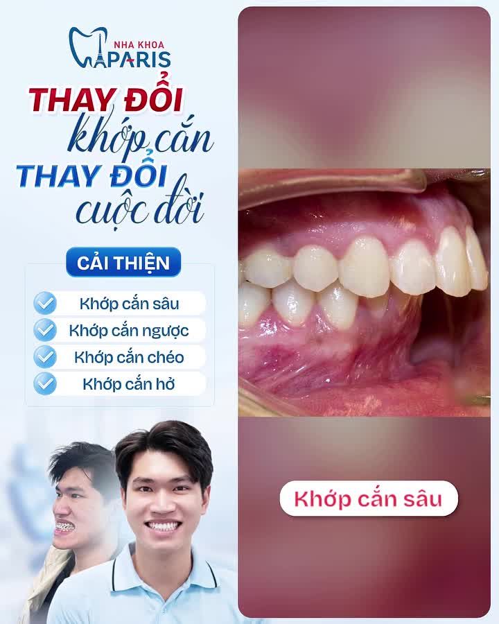 MÒN RĂNG, MÉO CẰM, BIẾN DẠNG KHUÔN MẶT – TẤT CẢ DO LỖI SAI KHỚP CẮN!