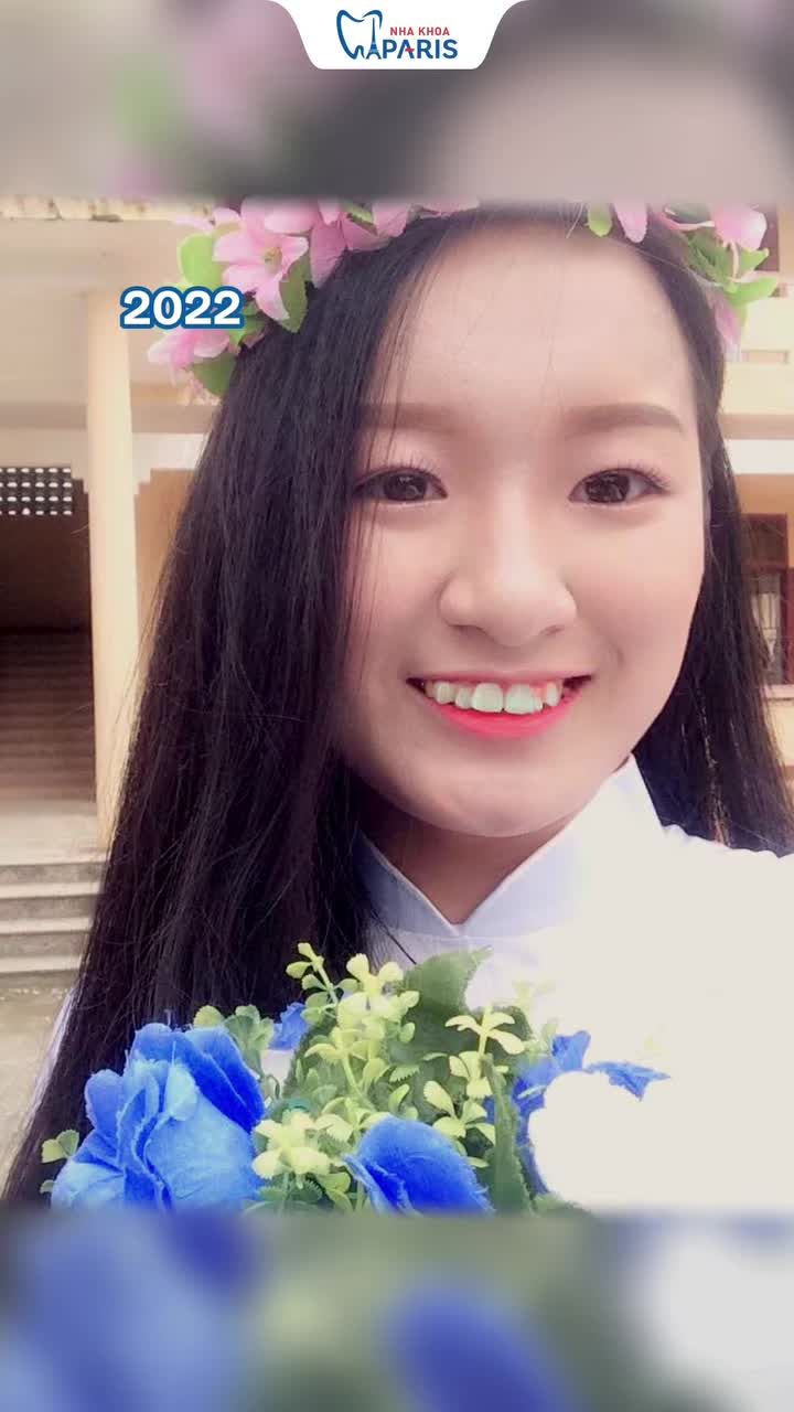 "Đánh đổi 2 năm niềng răng... rốt cuộc đổi lại được gì?"