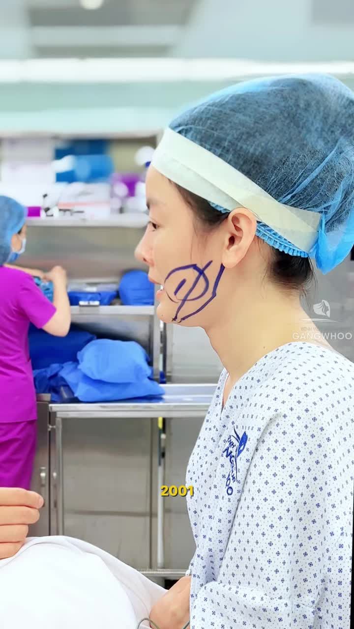 Gương mặt nhỏ nhưng hàm vuông to thì gọt hàm nội soi vi phẫu chính là giải pháp