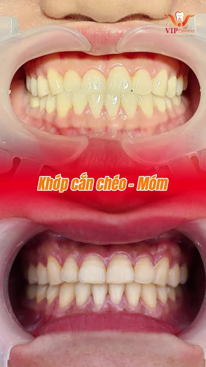 Khớp cắn chéo gây móm và lệch mặt
