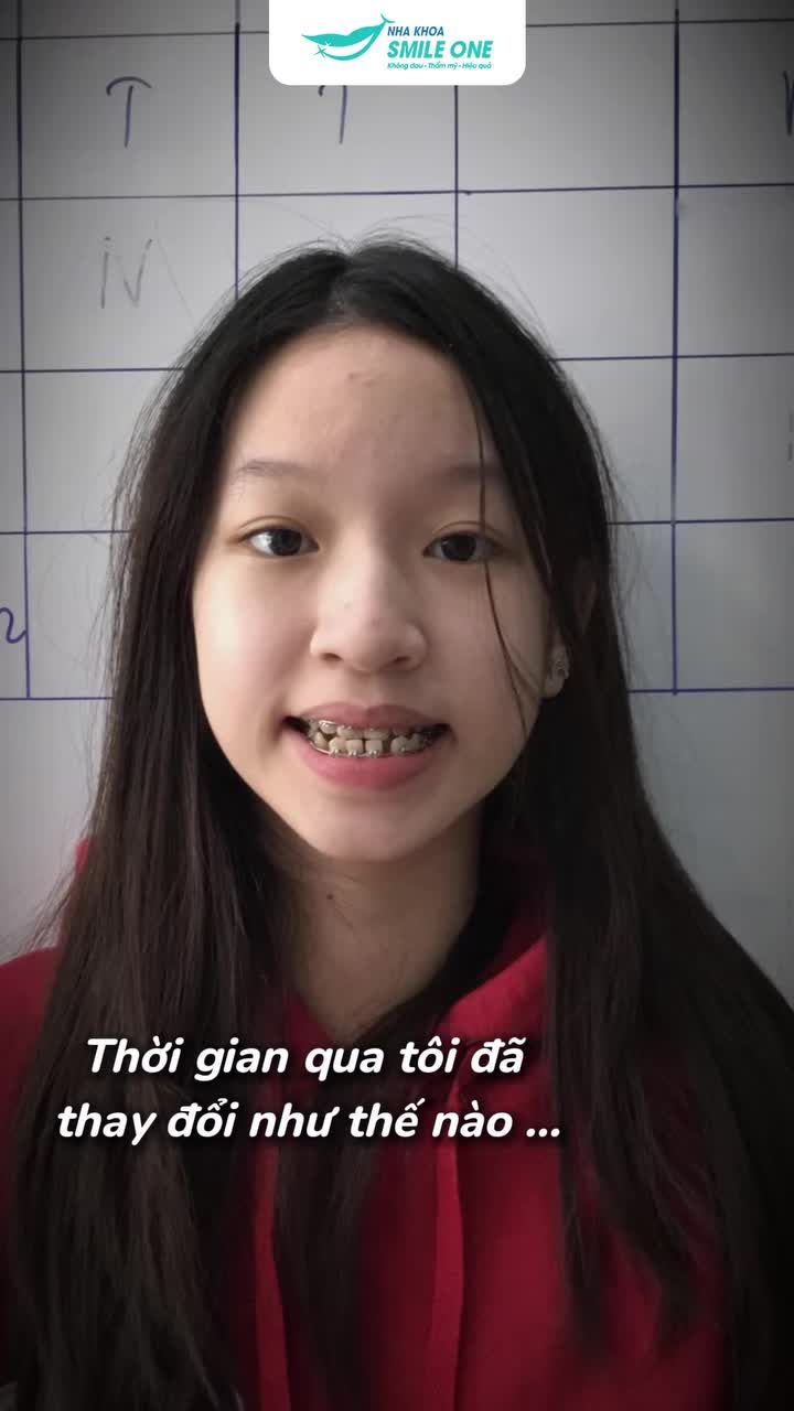 Phát hiện sớm khớp cắn ngược, sau 2 năm niềng răng Phương Trang đã chấm dứt tình trạng "móm".