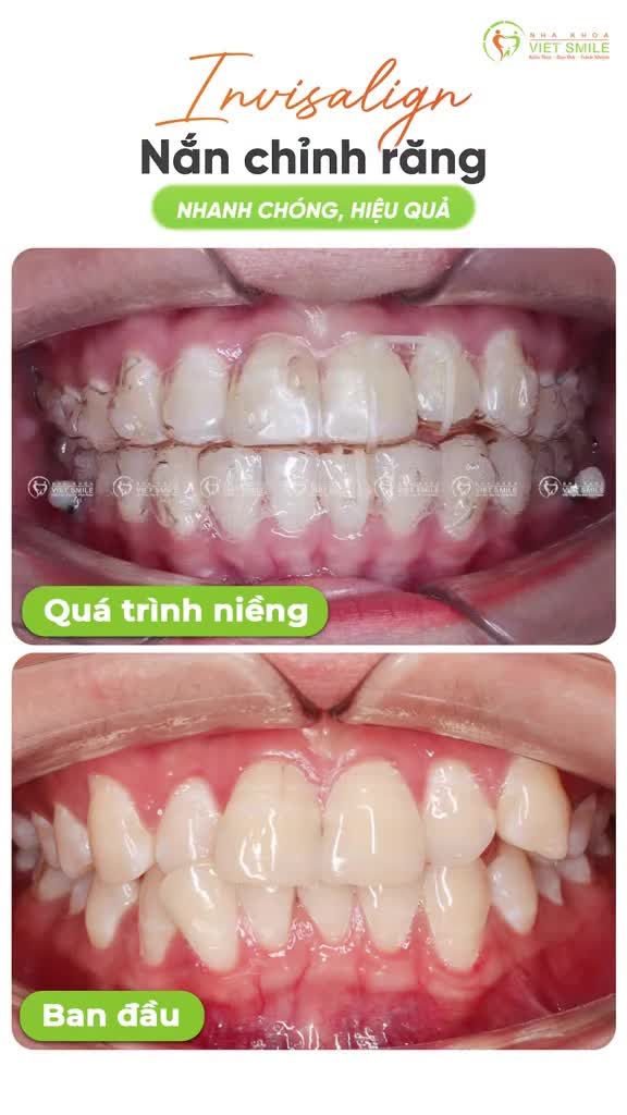 Chọn niềng răng Invisalign, chọn sự thoải mái, hiệu quả!