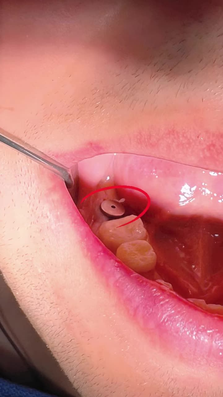 Một ca trồng răng cho anh khách từ Châu Âu