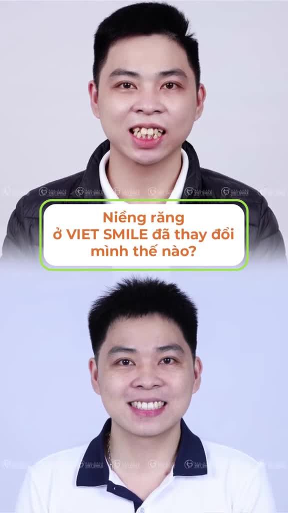 Niềng răng ở Viet Smile đã thay đổi thế nào?
