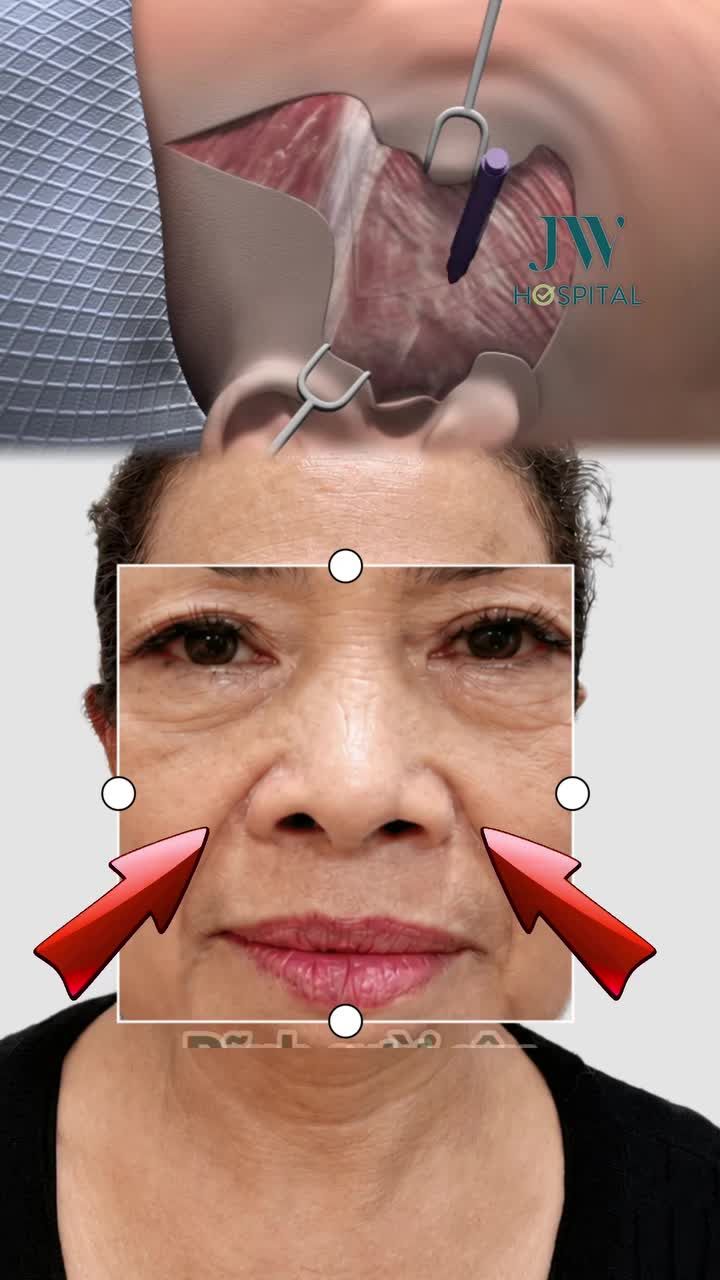 XOÁ GIÀ 20 TUỔI CHỈ SAU MỘT GIẤC NGỦ VỚI CĂNG DA MẶT SMAS PRO U60 TRẺ ĐẸP NHƯ U40