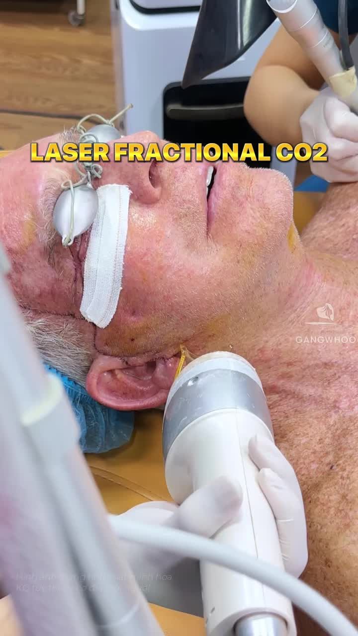 Điều trị đốm nâu, da không đều màu, bề mặt da sần bằng Laser Fractional Co2