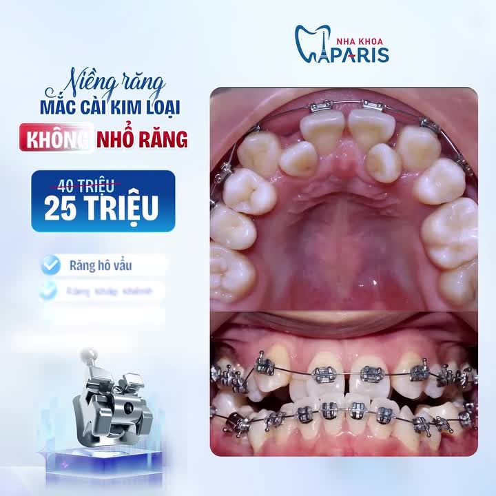 CHỐT DEAL HỜI NHẤT NĂM: NIỀNG RĂNG 3M – TIẾT KIỆM NGAY 15 TRIỆU!