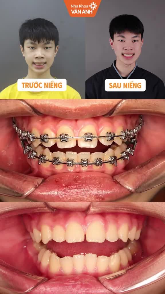 Cải thiện chất lượng nụ cười cùng NKVA