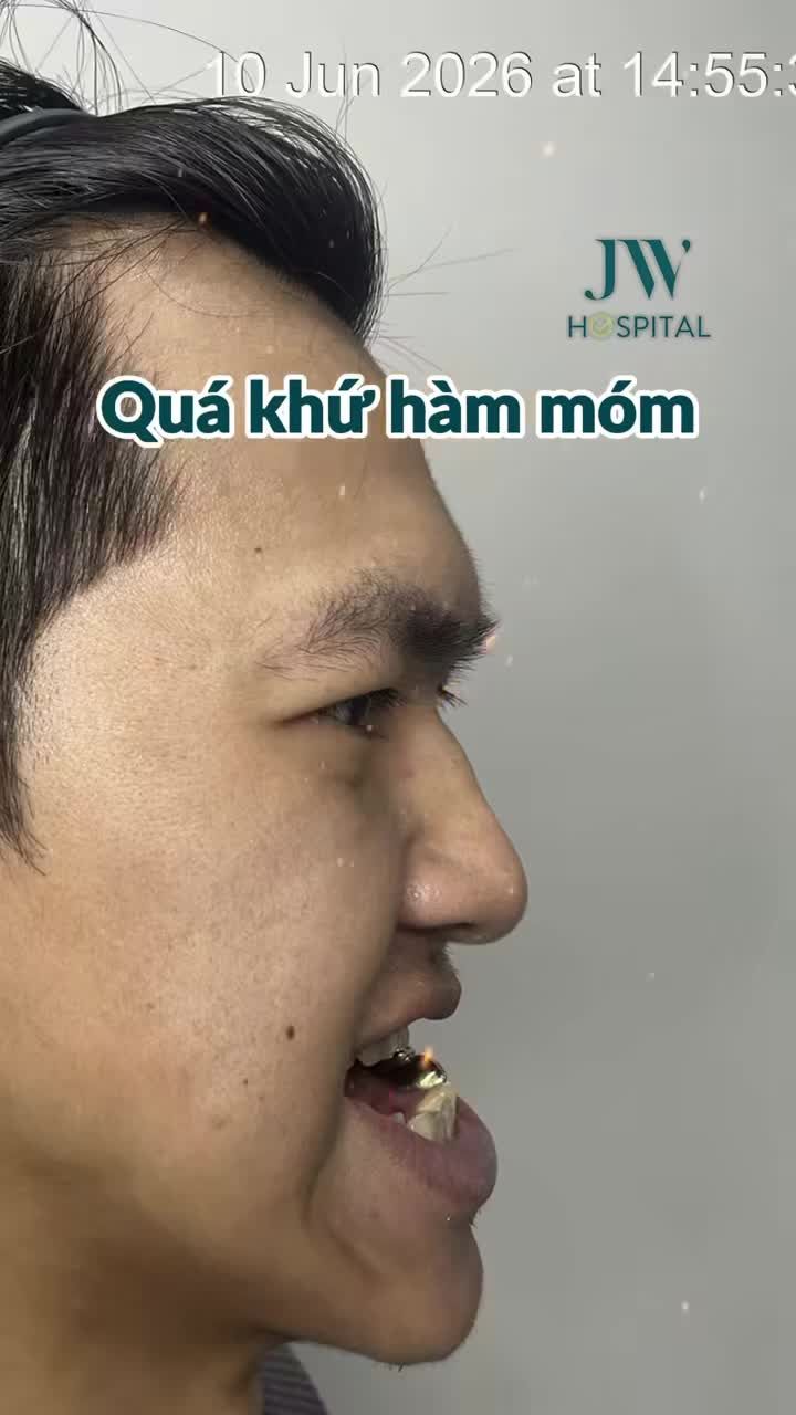 HÉ LỘ DIỆN MẠO MỚI NHẤT CỦA SODA CAMP SAU PHẪU THUẬT HÀM 2 LẦN