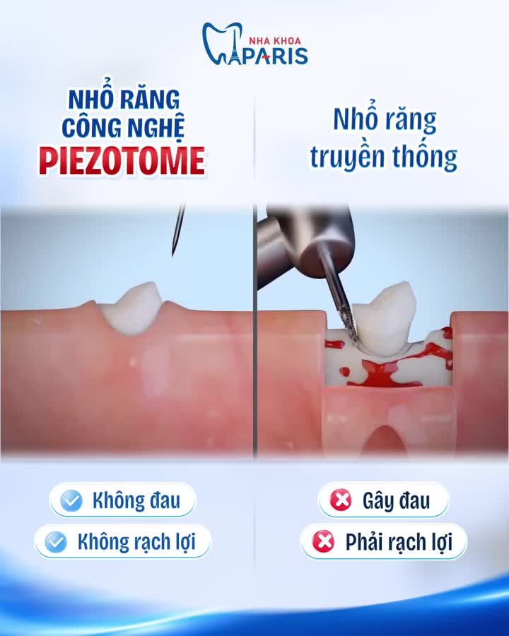 NHỔ RĂNG KHÔNG ĐAU VỚI CÔNG NGHỆ PIEZOTOME HIỆN ĐẠI