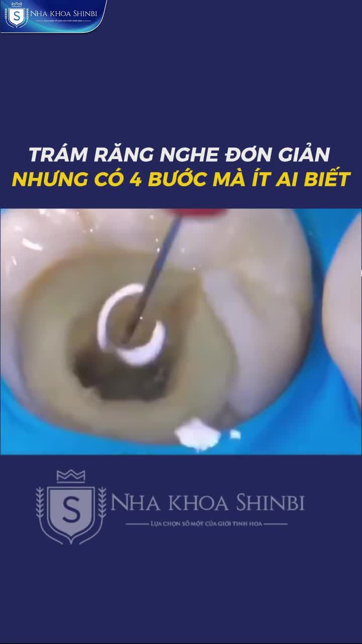 Trám răng  nghe đơn giản nhưng có 4 bước mà ít ai biết