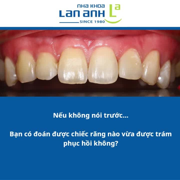 Trám răng mẻ góc đẹp đến mức... Không nói, không ai biết!