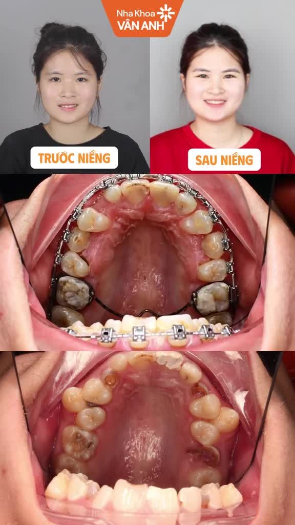 Nụ cười duyên sau 2,5 năm tháo niềng