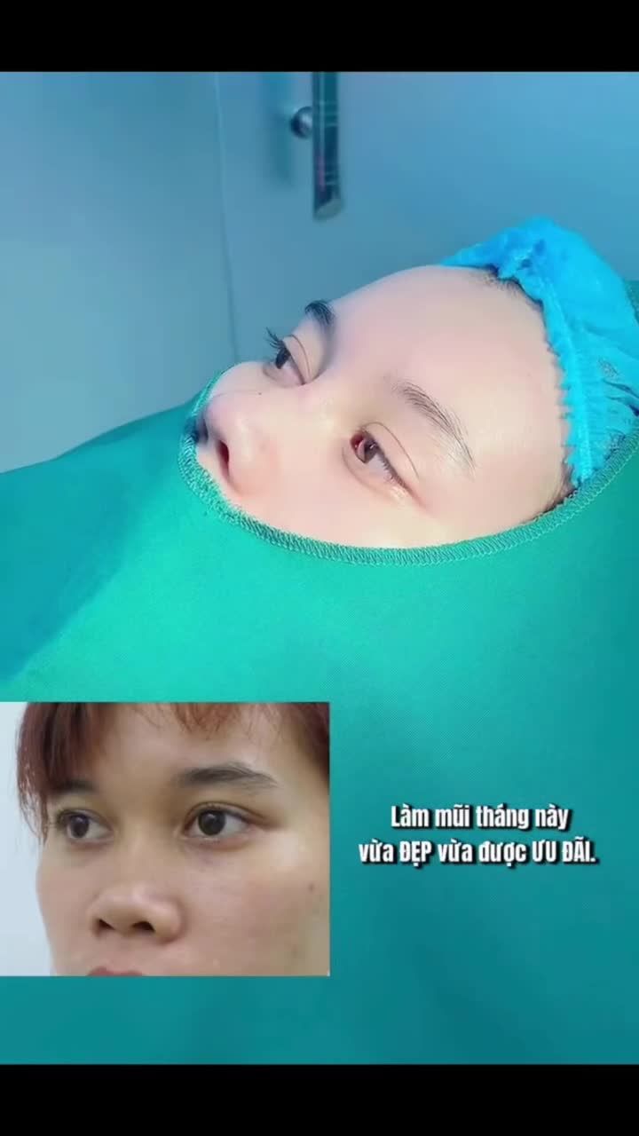 Đừng đợi "một ngày nào đó" mới làm mũi nữa nha. Hôm nay, tháng này chốt ngay  MŨI XINH với G.I.Á ƯU ĐÃI lên đến 7.500.000Đ siêu xinh, siêu deal.