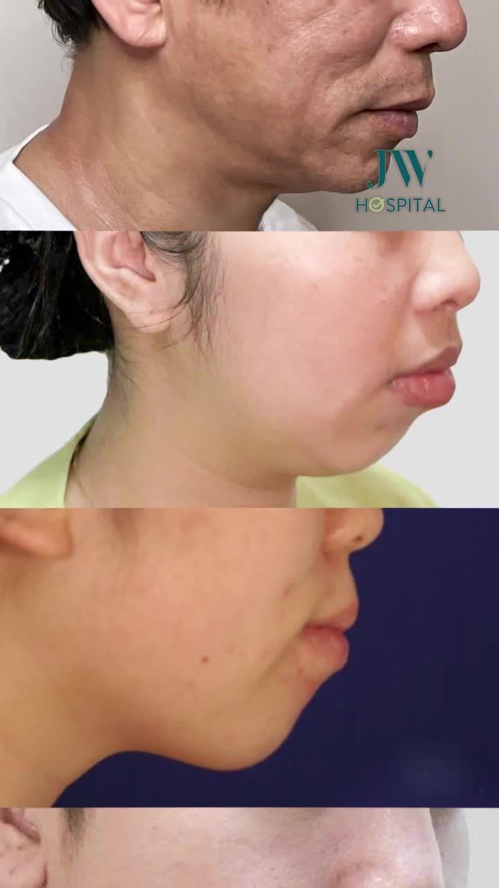 ĐỪNG TIÊM FILLER NỮA! XOÁ CẰM LẸM, CẰM NGẮN VĨNH VIỄN VỚI PHẪU THUẬT TRƯỢT CẰM TẠI JW