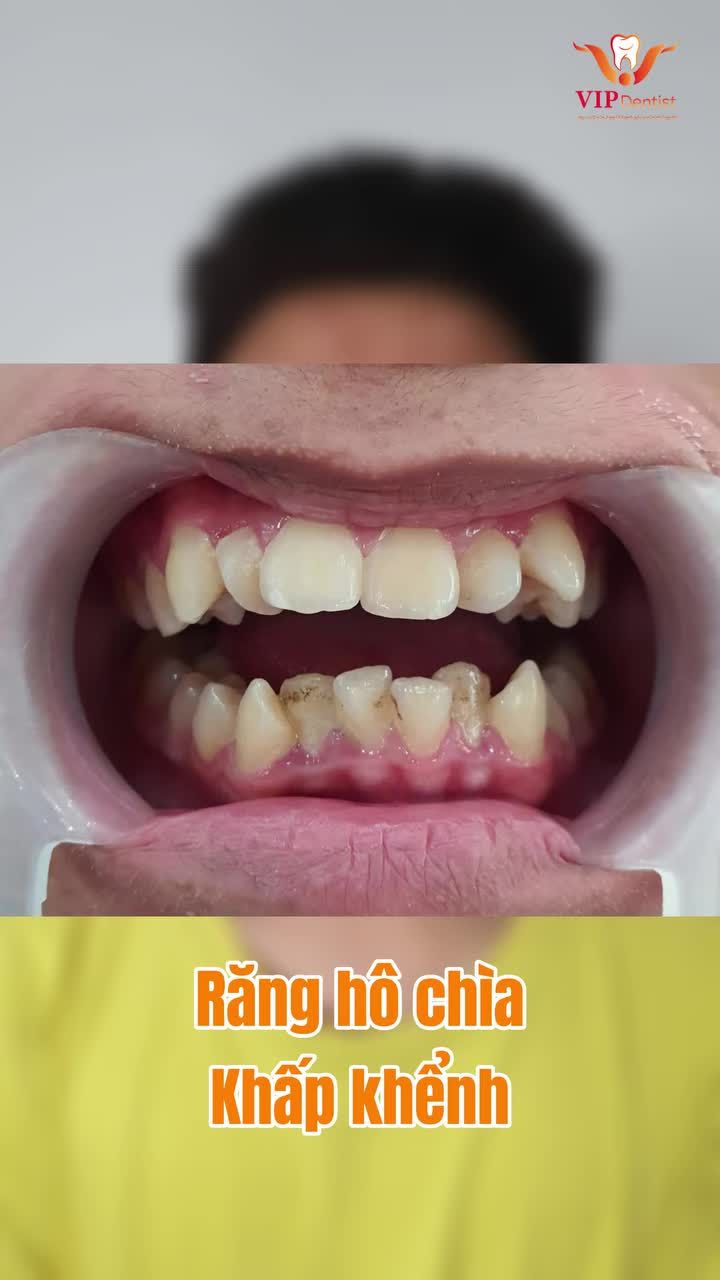 BẠN CÓ ĐANG GẶP PHẢI TÌNH TRẠNG GIỐNG NHƯ BẠN HOÀNG VIỆT BÁCH?