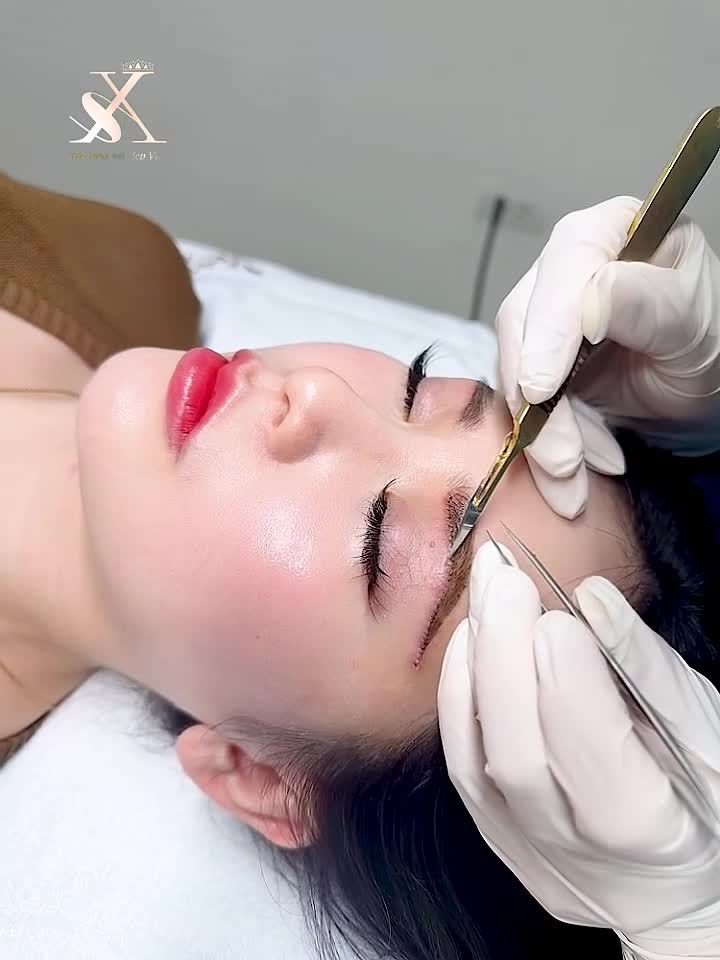 NÂNG CUNG MÀY - TIỂU PHẪU NHỎ, HIỆU QUẢ TO