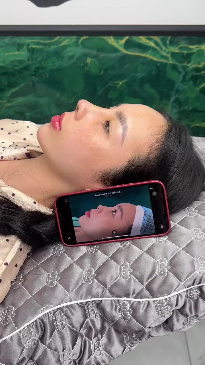 MŨI CẤU TRÚC SURGIFORM SAU 5 NGÀY – THAY ĐỔI NHAN SẮC RÕ RỆT