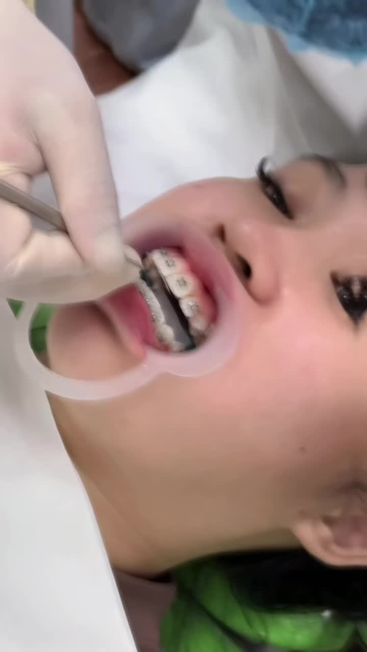 17s Gắn mắc cài cùng bác sĩ Nha Khoa Đăng Lưu nha