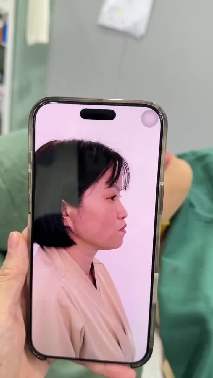 TRẢ KẾT QUẢ SAU 60 PHÚT THỰC HIỆN NÂNG MŨI CẤU TRÚC DR. HOẠT