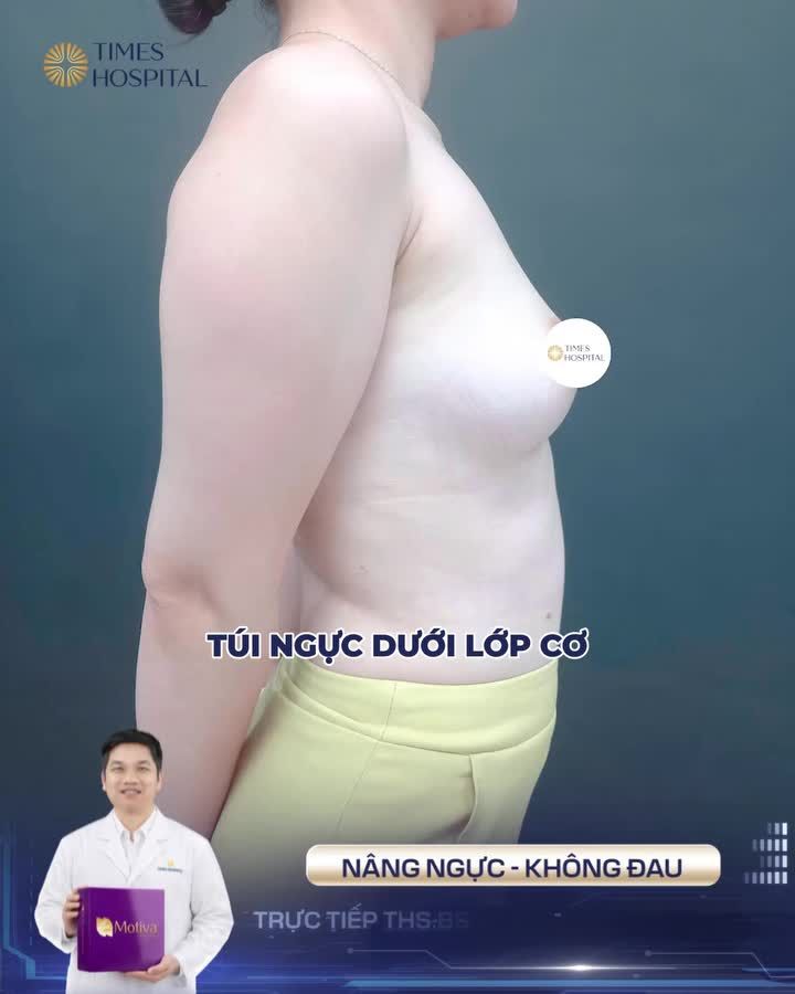 ĐẶT TÚI DUAL PLANE – GIẢI PHÁP KIẾN TẠO DÁNG NGỰC HÀI HÒA, TỰ NHIÊN