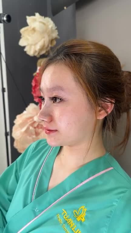 Mũi bọc sụn sau phẫu thuật