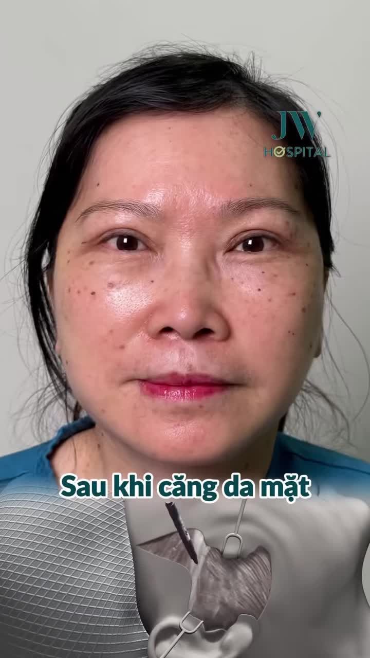 TRẺ 20 TUỔI, ĐẸP TRỌN ĐỜI SAU 1 LẦN CĂNG DA MẶT TẠI BỆNH VIỆN JW - BẠN CÓ TIN KΗÔΝG?