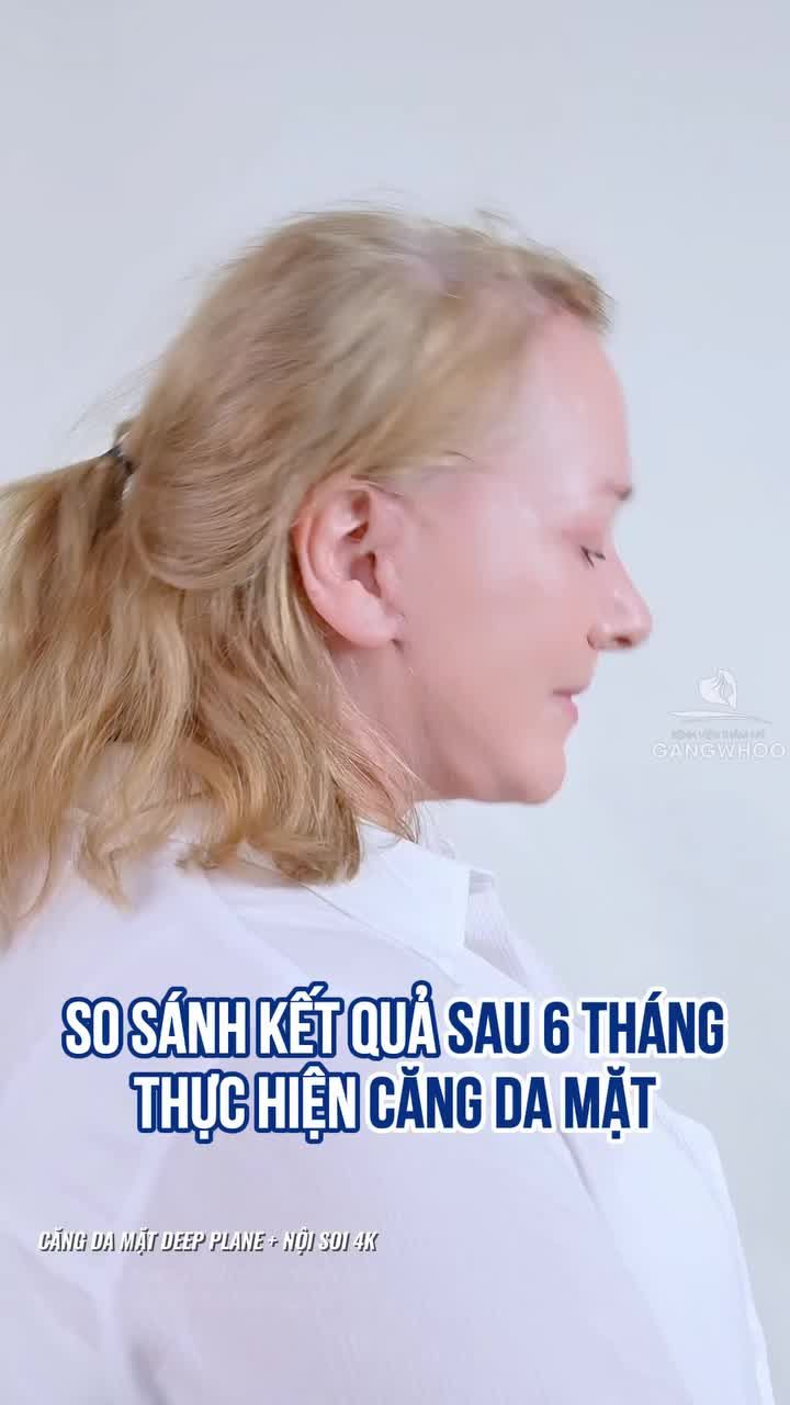 Khách Quốc Tế quay lại làm thêm dịch vụ sau 6 tháng hài lòng về chất lượng và kết quả căng da mặt toàn phần + Deep Plane nội soi 4K