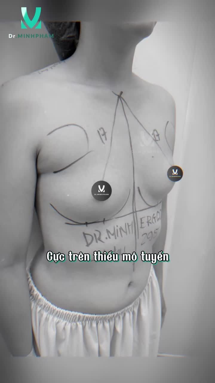 Chỉ ngay sau phẫu thuật, vòng 1 đã có sự thay đổi rõ rệt với dáng ngực đầy đặn, cân đối và hài hòa hơn với vóc dáng