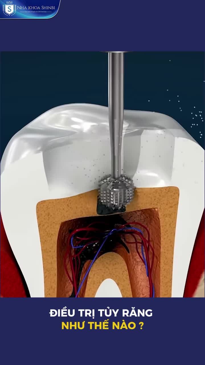 Điều trị tủy răng như thế nào ?