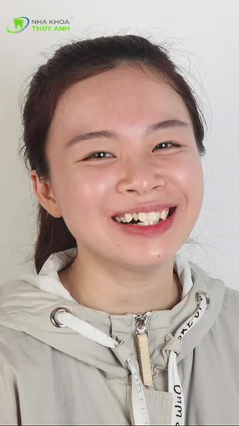 CẬN CẢNH SỰ THAY ĐỔI SAU 2 NĂM ĐEO NIỀNG RĂNG