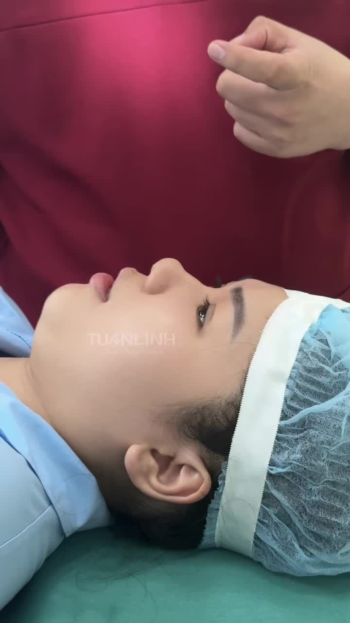 2 NĂM SAU NÂNG MŨI CHỈ – QUYẾT ĐỊNH SỬA LẠI ĐỂ CÓ DÁNG MŨI NHƯ MONG MUỐN