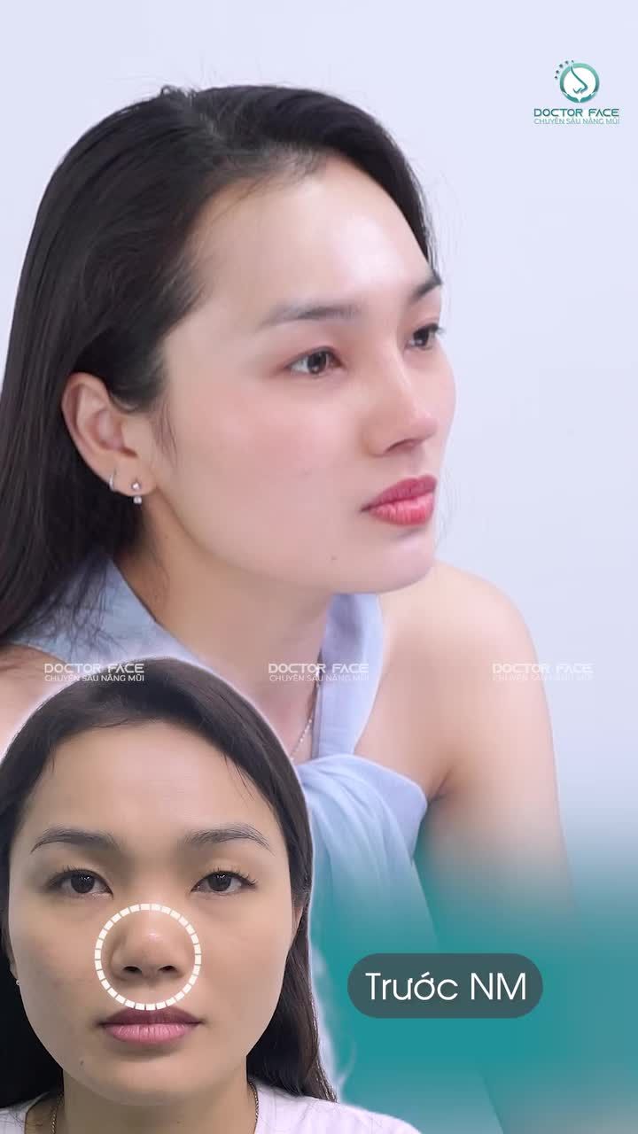 Bác sĩ ở Mỹ nói một điều, về Dr Face bác sĩ Phương cũng phân tích đúng điều đó. Và đó là lúc chị quyết định s.ửa m.ũi. ✈️