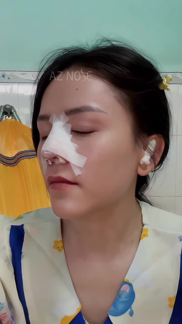 Nâng mũi - hóa ra cũng nhẹ nhàng ghê