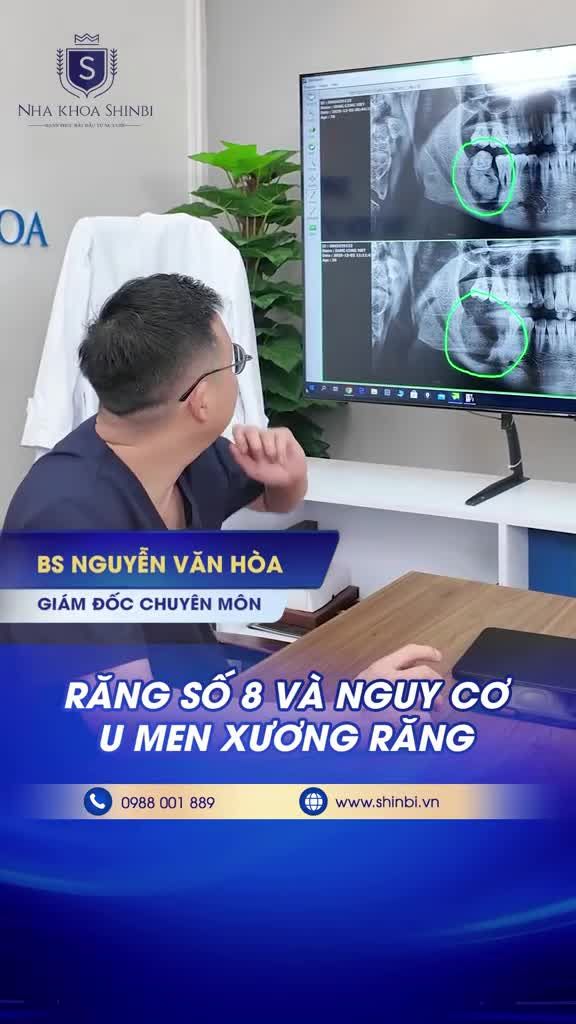 Răng số 8 và Nguy Cơ U Men Xương Răng