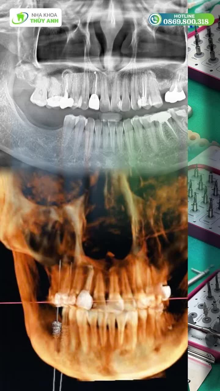 30 GIÂY XEM TRỌN MỘT CA CẤY IMPLANT BẰNG MÁNG HƯỚNG DẪN PHẪU THUẬT