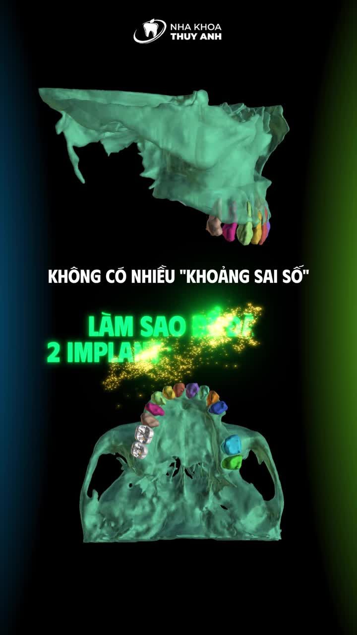 ĐIỀU GÌ XẢY RA NẾU CHỈ ĐẶT LỆCH IMPLANT VÀI MILIMET?
