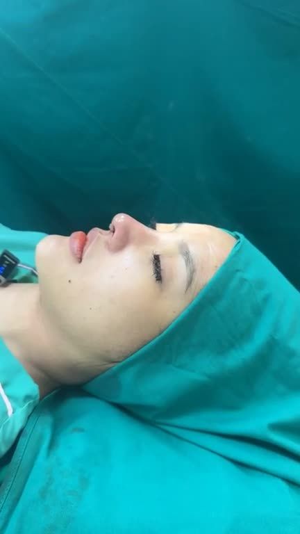 Mũi tái cấu sau phẫu thuật