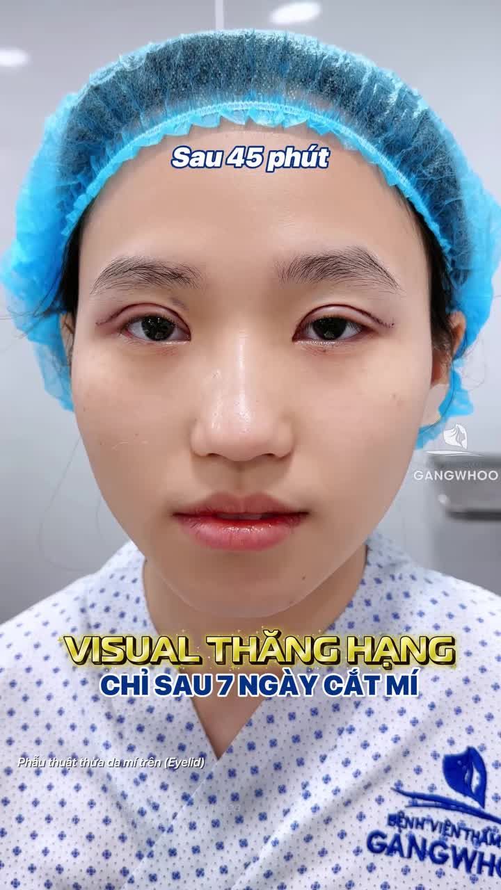 Visual thăng hạng chỉ sau 7 ngày cắt mí