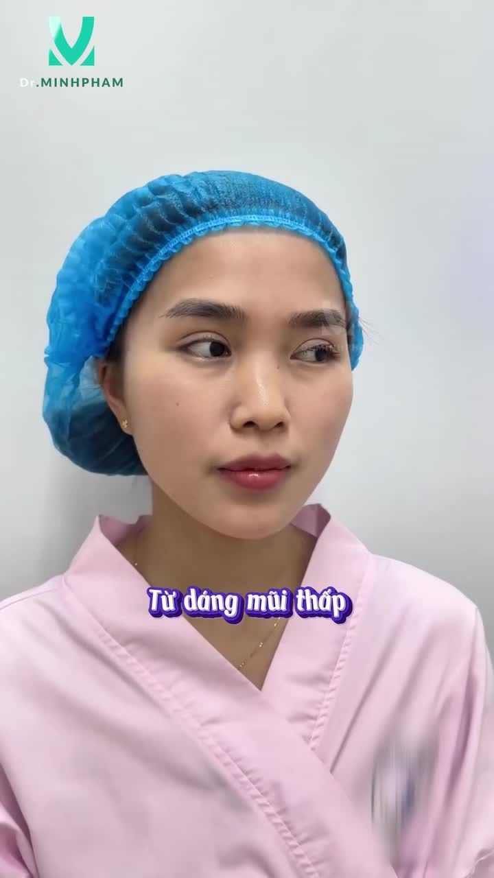 Chỉ một thay đổi nhỏ ở dáng mũi cũng có thể mang đến sự khác biệt rõ rệt cho tổng thể gương mặt.