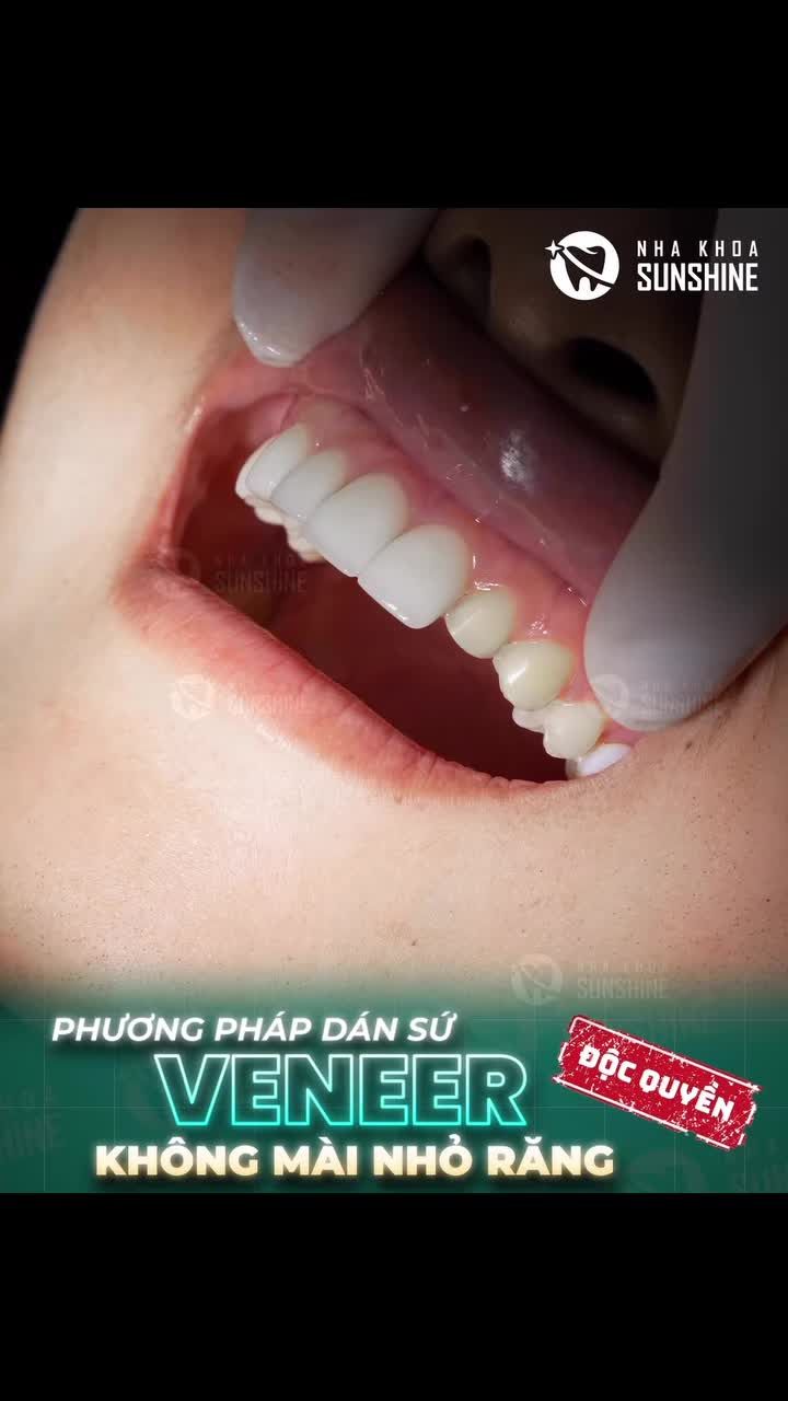CẬN CẢNH DÁN SỨ VENEER KHÔNG MÀI NHỎ RĂNG TẠI SUNSHINE