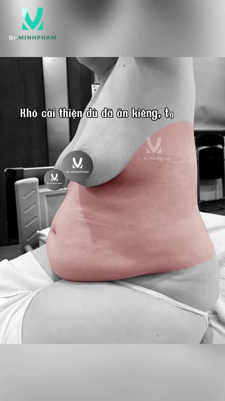 Sau sinh, điều nhiều chị em mong muốn không chỉ là giảm mỡ mà còn là lấy lại vòng eo thon gọn và sự tự tin.