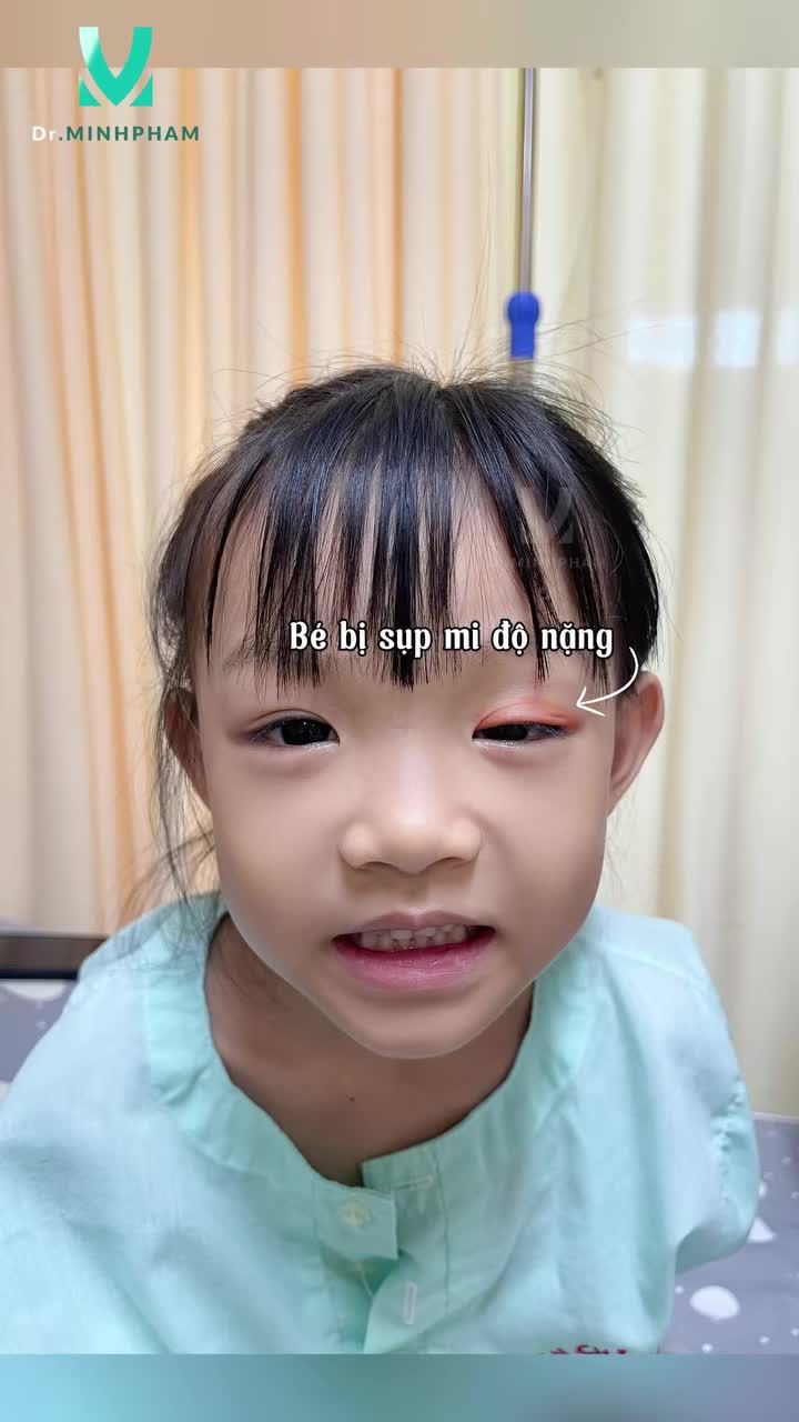 Một năm sau phẫu thuật điều trị sụp mí bẩm sinh bằng phương pháp treo vạt cơ trán, mắt bé Bảo Hân vẫn suy trì kết quả ổn định