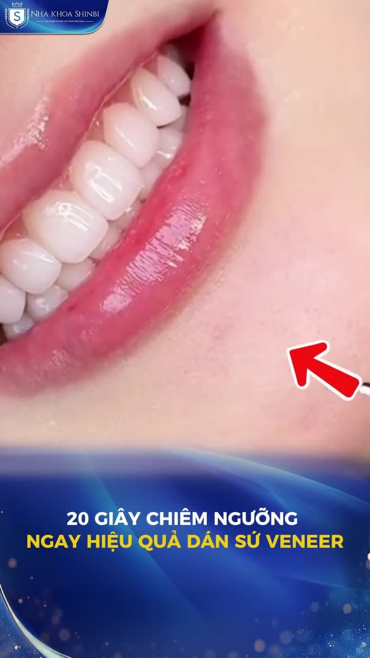 20 giây chiêm ngưỡng ngay hiệu quả dán sứ Veneer