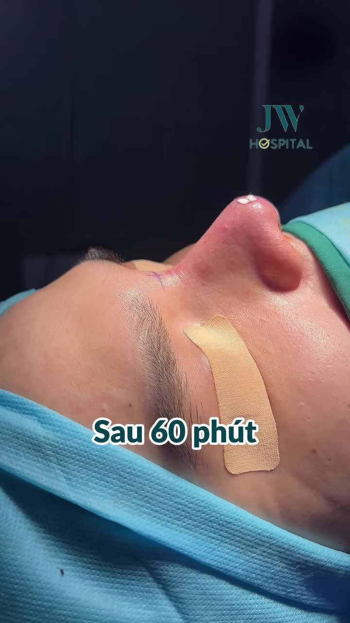 CHÀNG TRAI ĐÁNH ĐỔI TẤT CẢ BAY TỪ MỸ VỀ JW NÂNG MŨI ĐỔI MẶT HOTBOY ĐIỂN TRAI