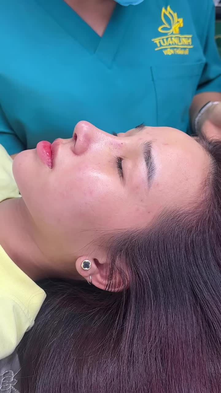Mũi cấu trúc sau 10 ngày