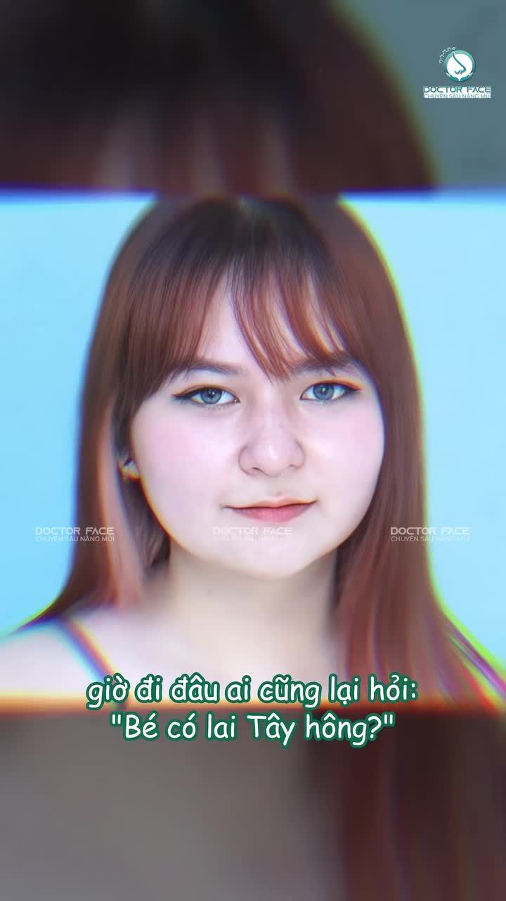 Bày đặt đi n.âng m.ũi, giờ ai gặp cũng tưởng gái lai Tây